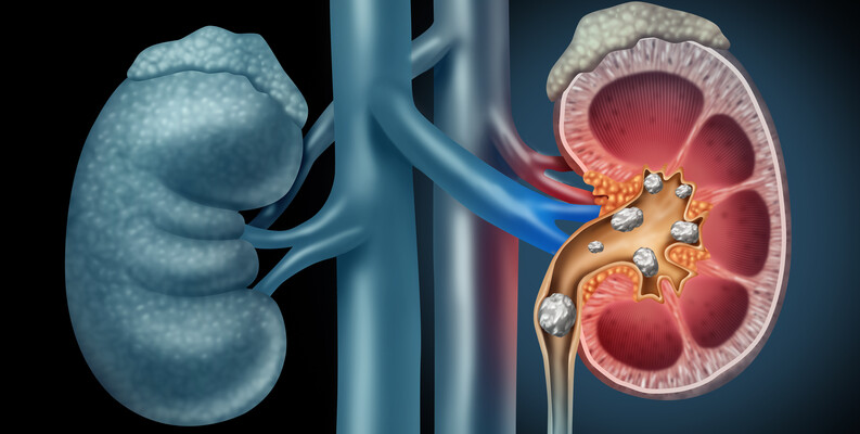 Renal Stone Detection Research